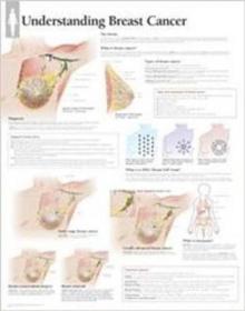 Understanding Breast Cancer Laminated Poster